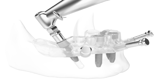 https://drsabadentalclinic.com/wp-content/uploads/2023/12/Dental-Implant-Surgery.jpg