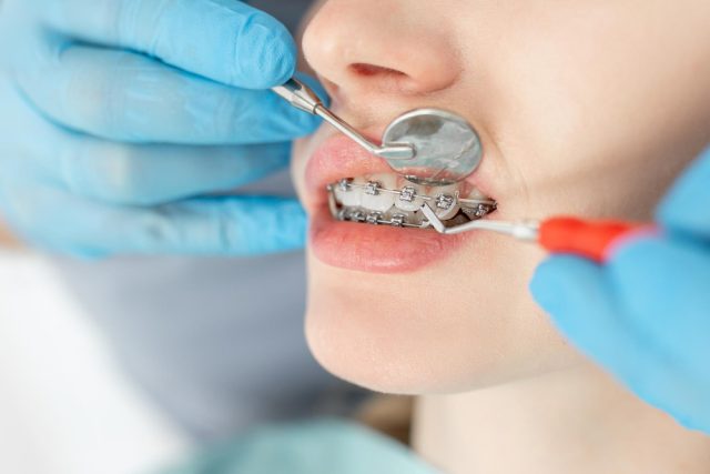 https://drsabadentalclinic.com/wp-content/uploads/2023/12/teethcorrection2-640x427.jpg