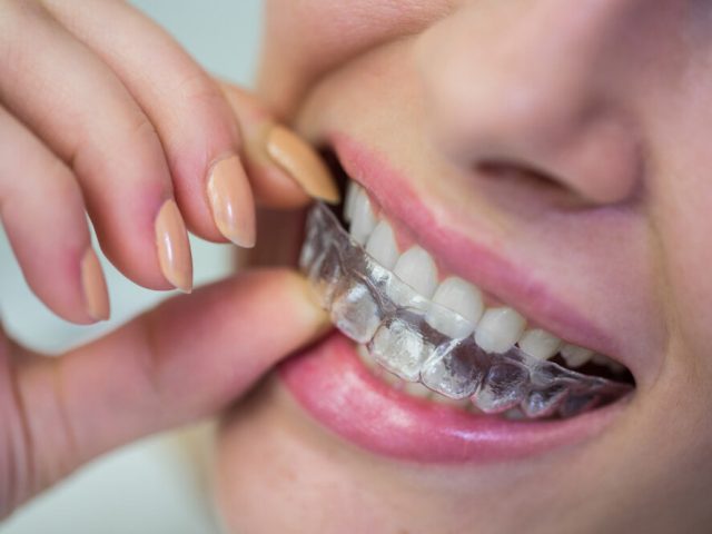 https://drsabadentalclinic.com/wp-content/uploads/2024/02/TEETHCORRECT33-640x480.jpg