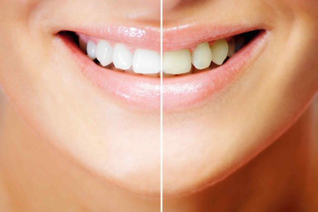 https://drsabadentalclinic.com/wp-content/uploads/2024/02/TEETHWHITENING22-640x427.jpg